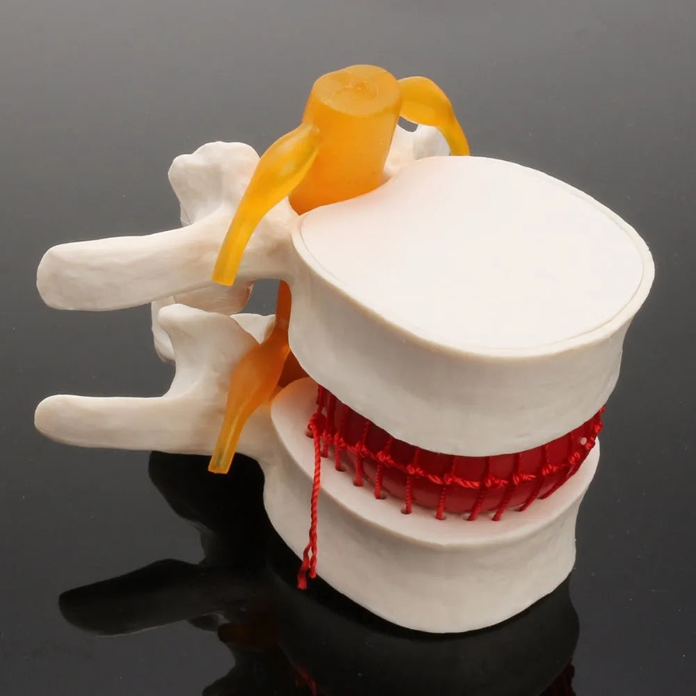 White PVC medical model of lumbar intervertebral disc showing herniated condition for anatomical demonstration