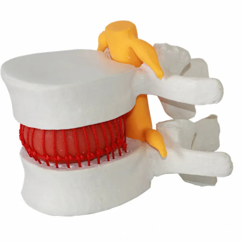 White PVC medical model of lumbar intervertebral disc showing herniated condition for anatomical demonstration