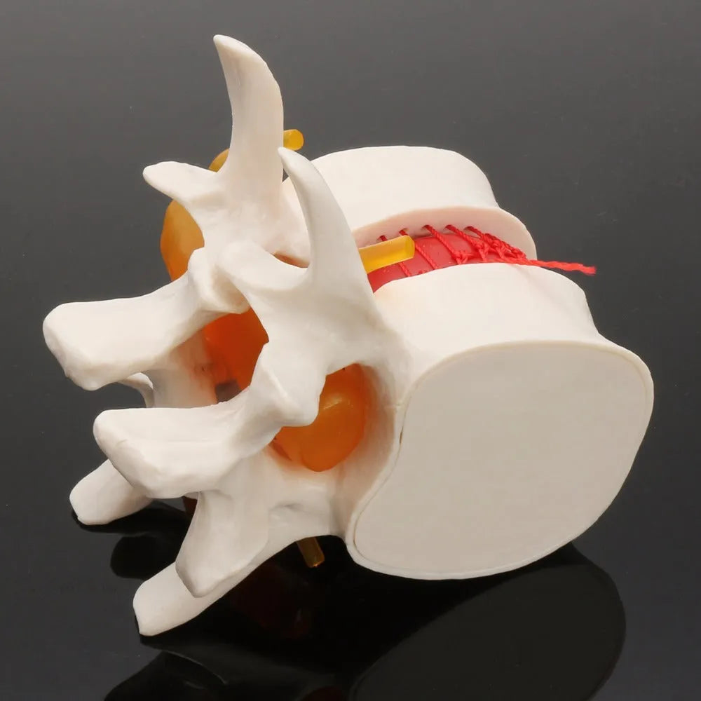 White PVC medical model of lumbar intervertebral disc showing herniated condition for anatomical demonstration