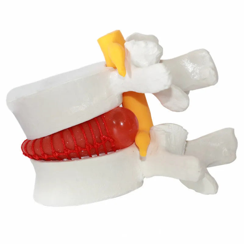 White PVC medical model of lumbar intervertebral disc showing herniated condition for anatomical demonstration