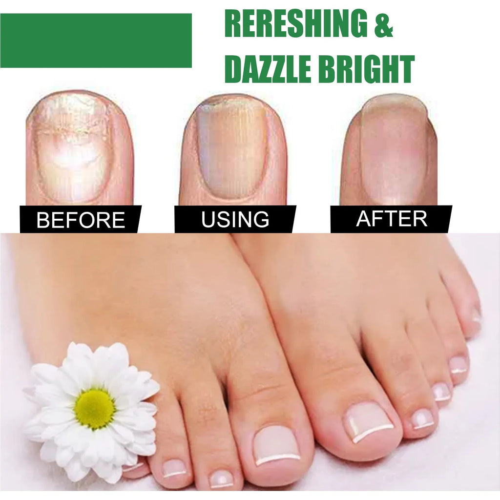 30ml tea tree oil nail repair solution bottle for hand and foot nail care treatment