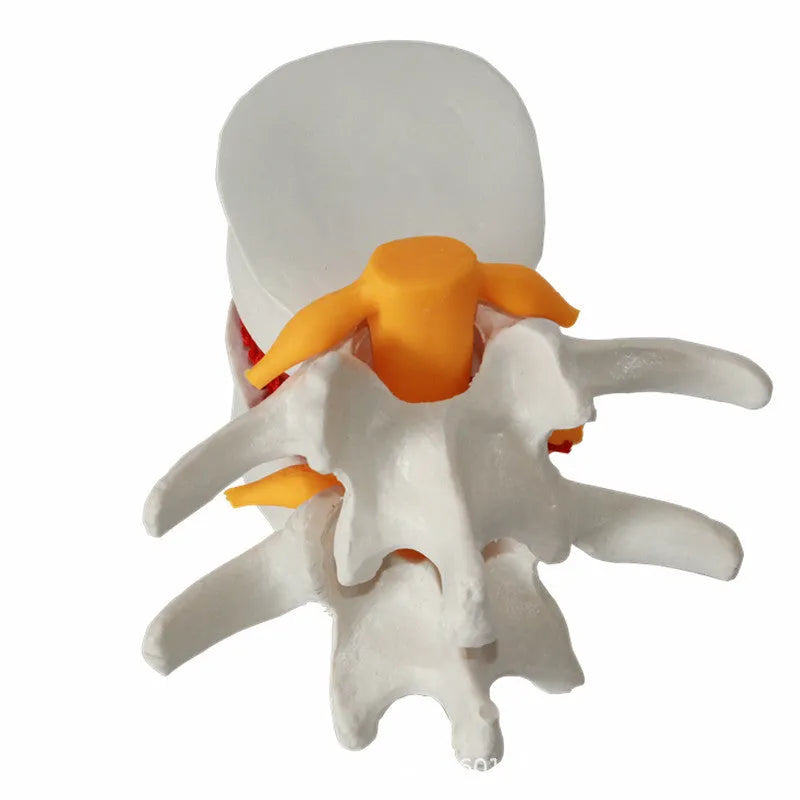 White PVC medical model of lumbar intervertebral disc showing herniated condition for anatomical demonstration
