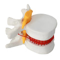 White PVC medical model of lumbar intervertebral disc showing herniated condition for anatomical demonstration