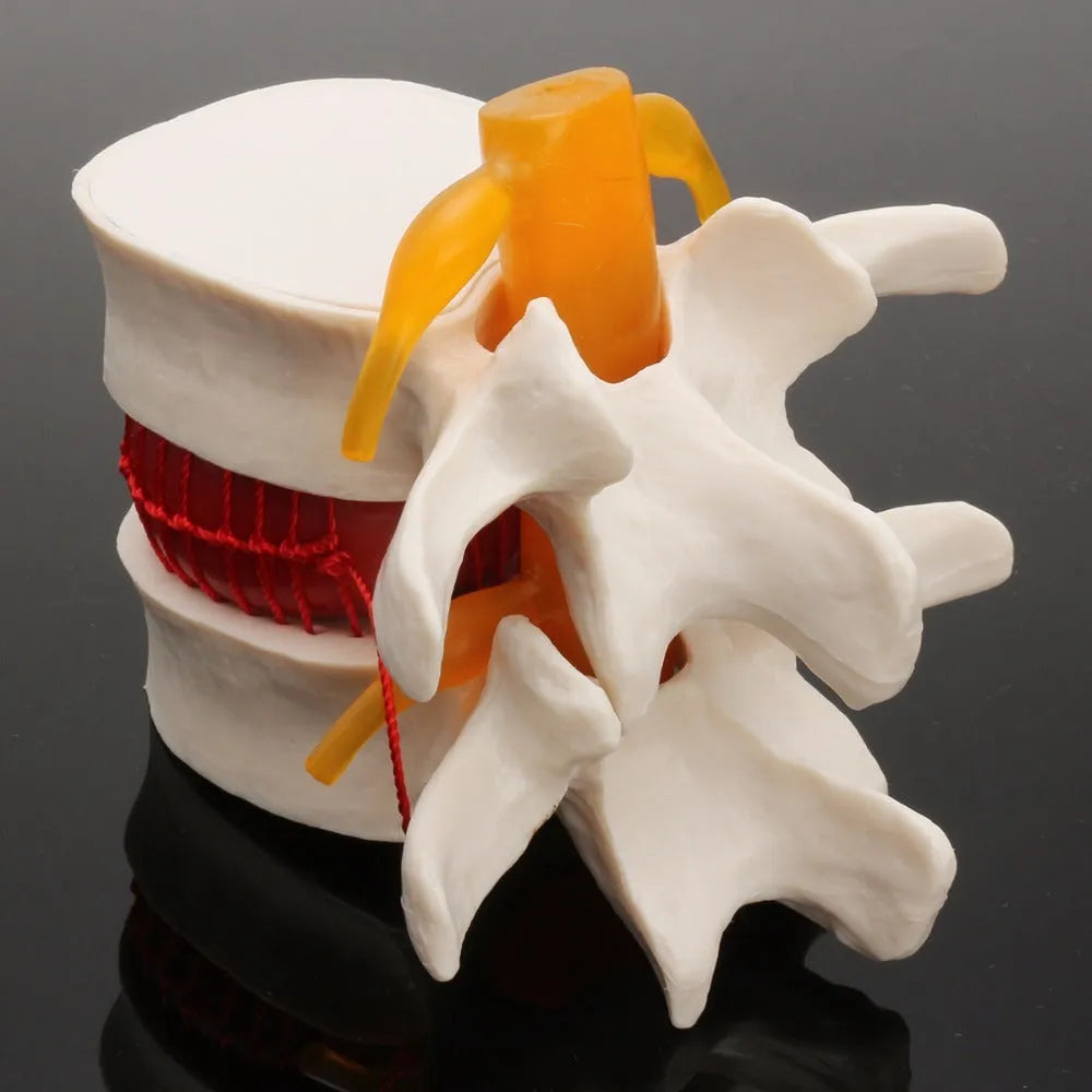 White PVC medical model of lumbar intervertebral disc showing herniated condition for anatomical demonstration