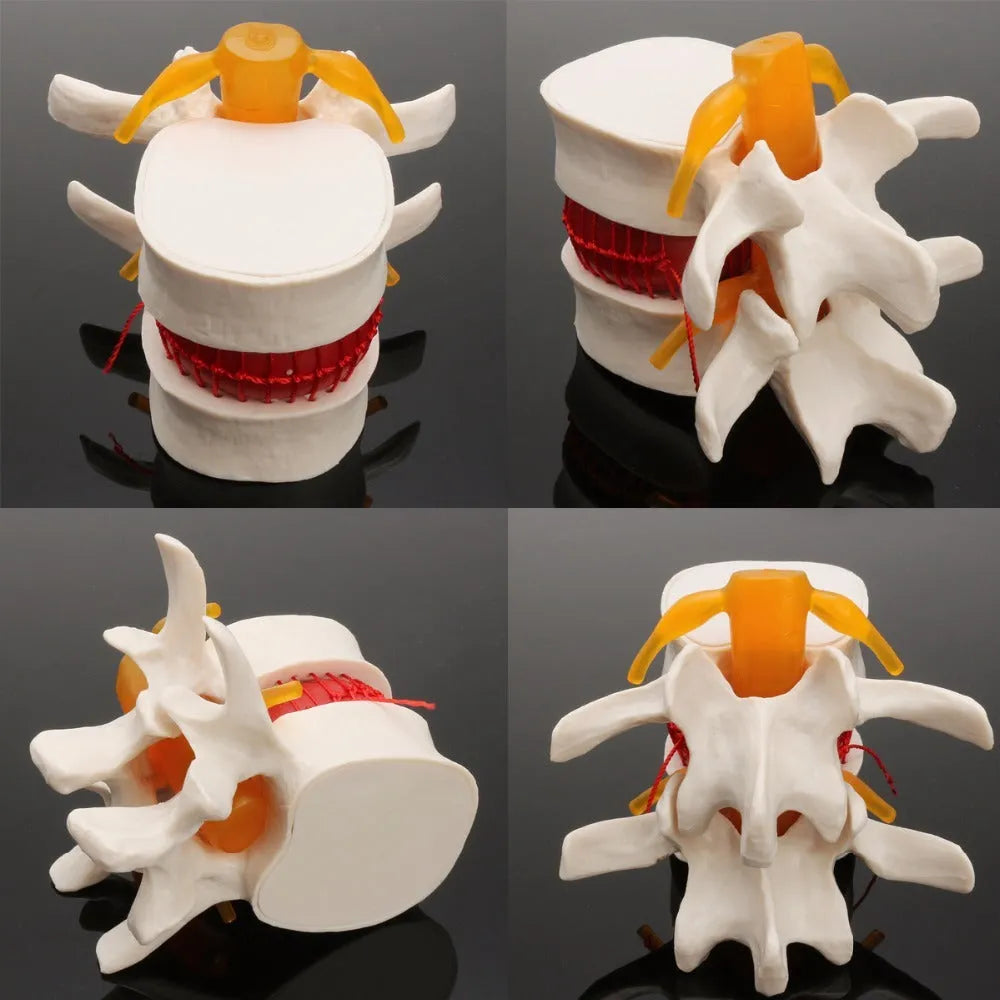 White PVC medical model of lumbar intervertebral disc showing herniated condition for anatomical demonstration