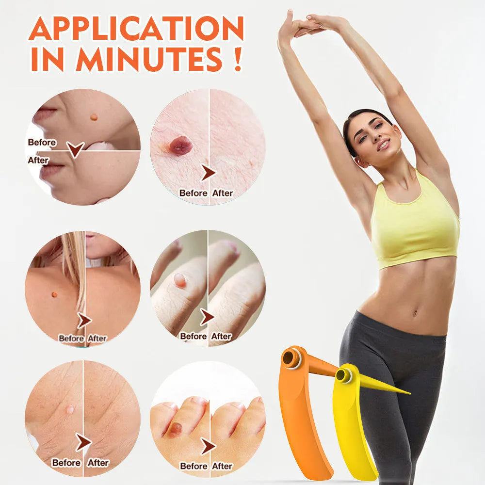 Orange yellow wart removal tool kit with devices, rubber rings, alcohol swabs, and accessories