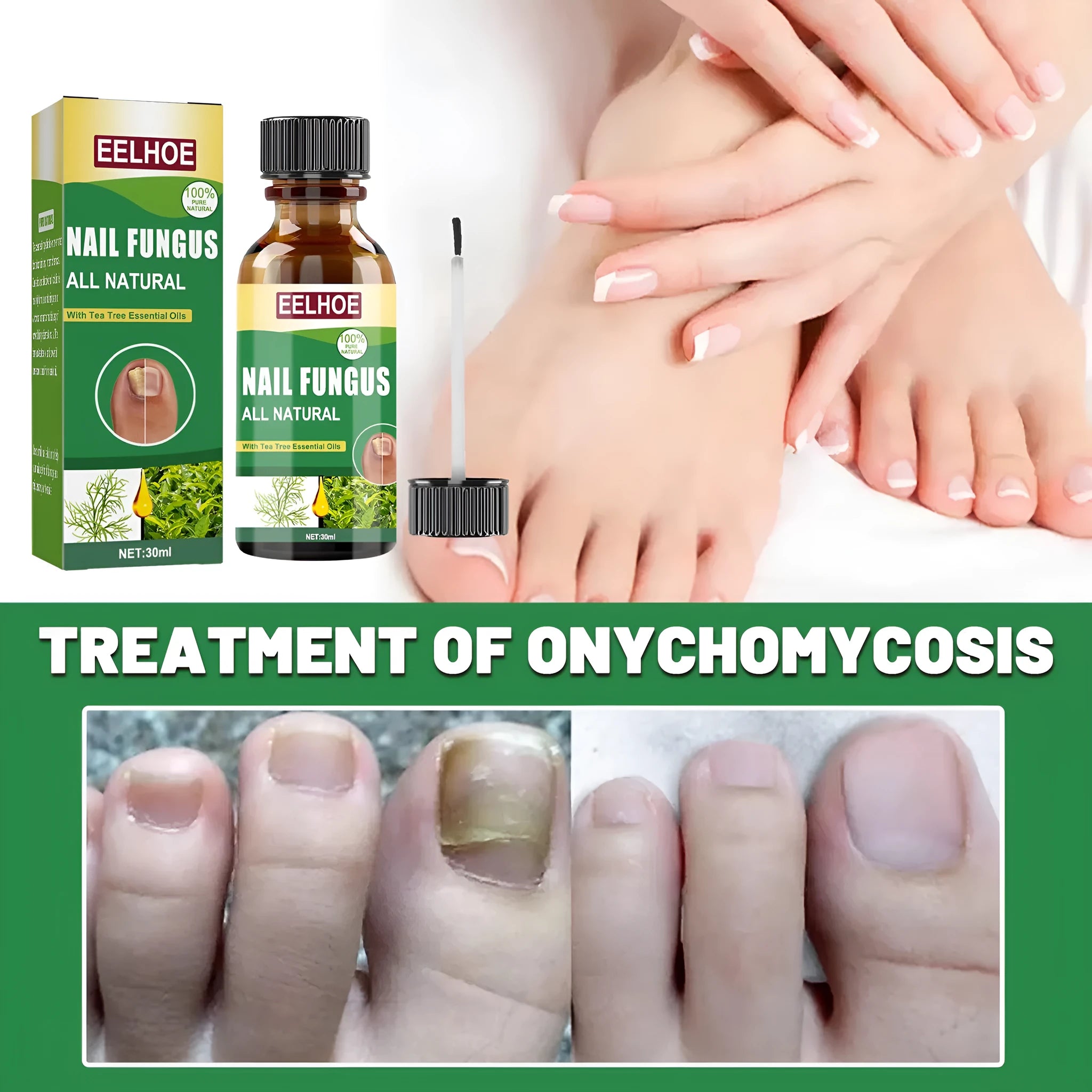 30ml tea tree oil nail repair solution bottle for hand and foot nail care treatment
