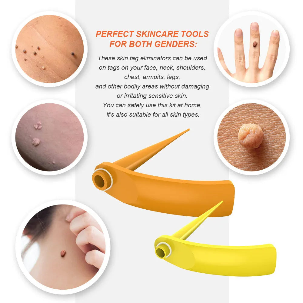 Orange yellow wart removal tool kit with devices, rubber rings, alcohol swabs, and accessories